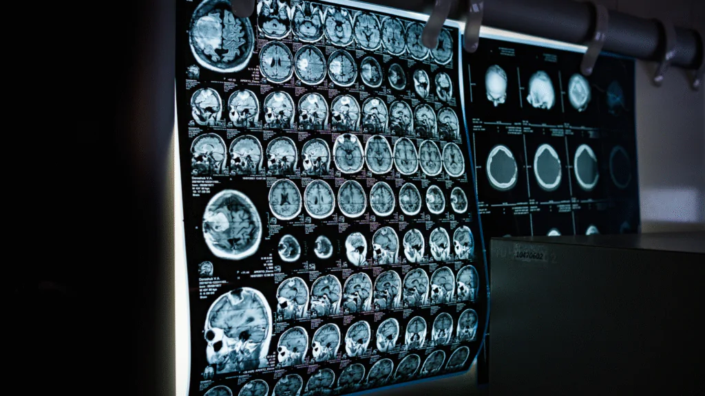 Brain Scan Interpretation, AI in Healthcare