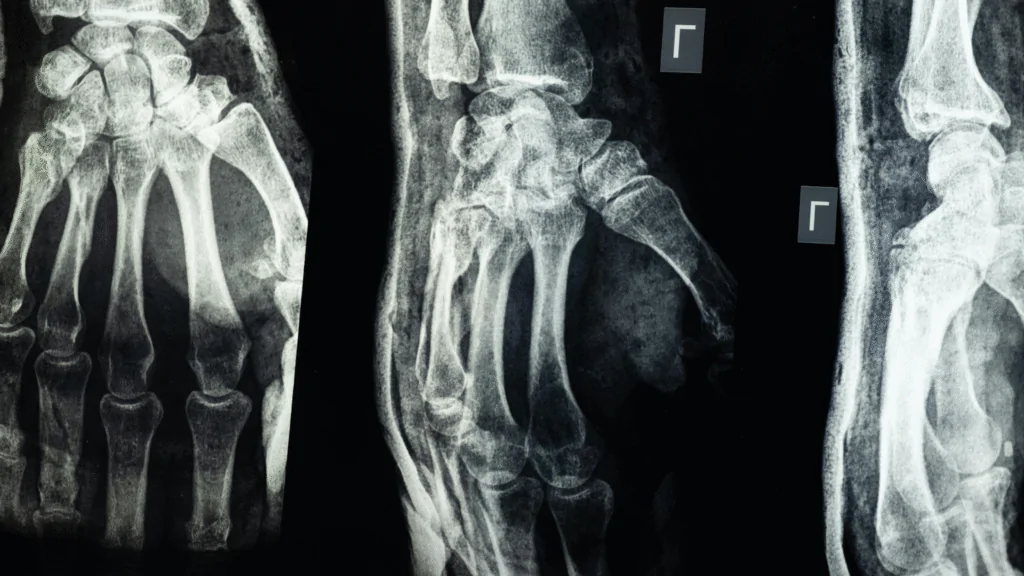 AI in Healthcare, Detection of Bone Fractures